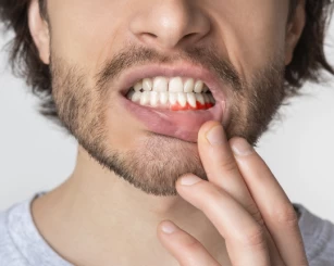 Gengiva inflamada e dolorida: Descubra a possível causa e tratamento!