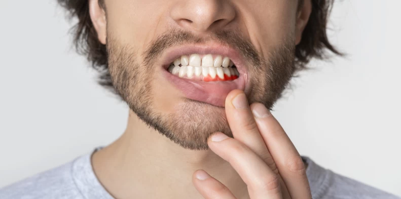 Gengiva inflamada e dolorida: Descubra a possível causa e tratamento!