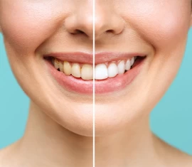 Tudo sobre clareamento dental: Dicas, tipos de tratamento e cuidados